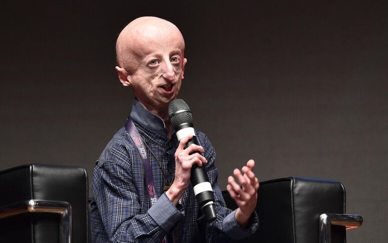 Murió con 28 años italiano que visibilizó el síndrome que le envejecía prematuramente