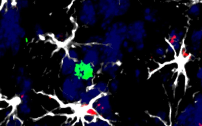 Desarrollan una linterna molecular para detectar metástasis en zonas profundas del cerebro
