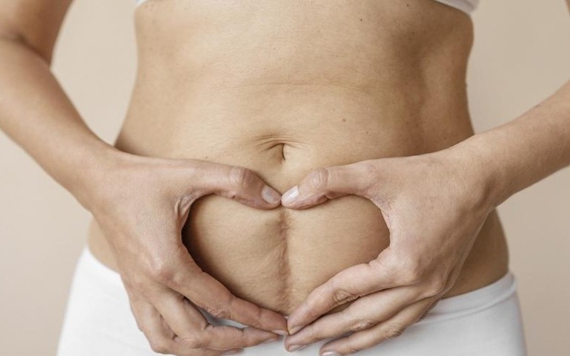 Conoce cómo tratar la diástasis abdominal