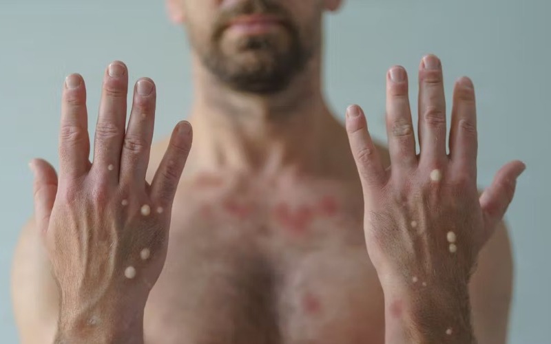 África registra más de 42.300 casos y 1.100 muertes por mpox en 18 países