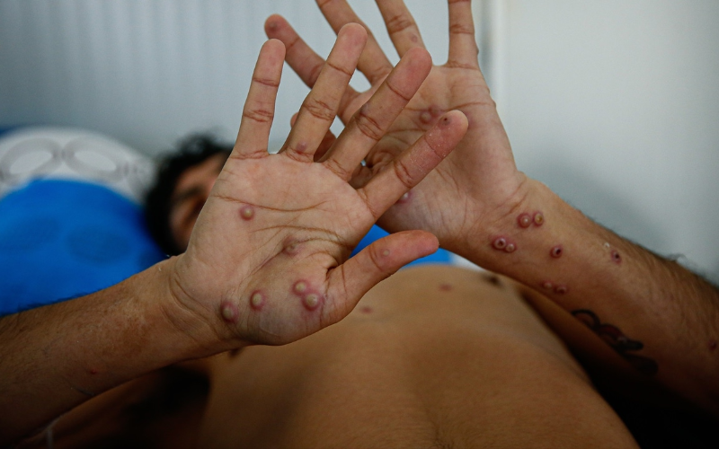Reino Unido confirma dos nuevos casos de una nueva variante más contagiosa de mpox