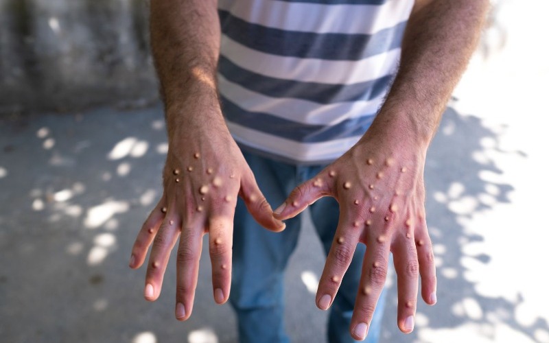 Casi 60.000 casos y 1.164 muertes por mpox durante 2024 en veinte países de África