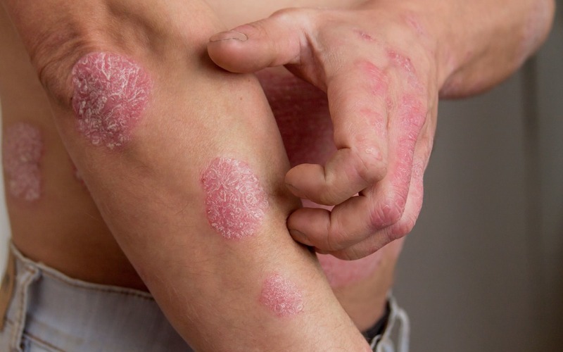 ¿Qué es la psoriasis nerviosa y cómo identificarla?
