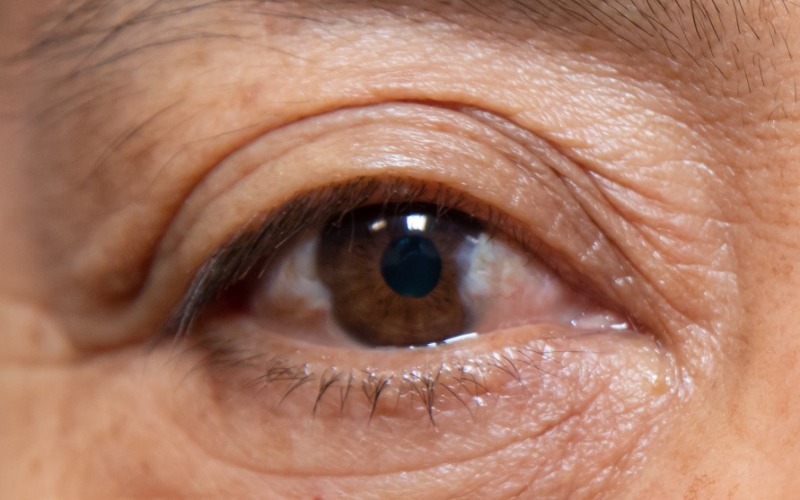 pterygium_before-21a6fe.jpg